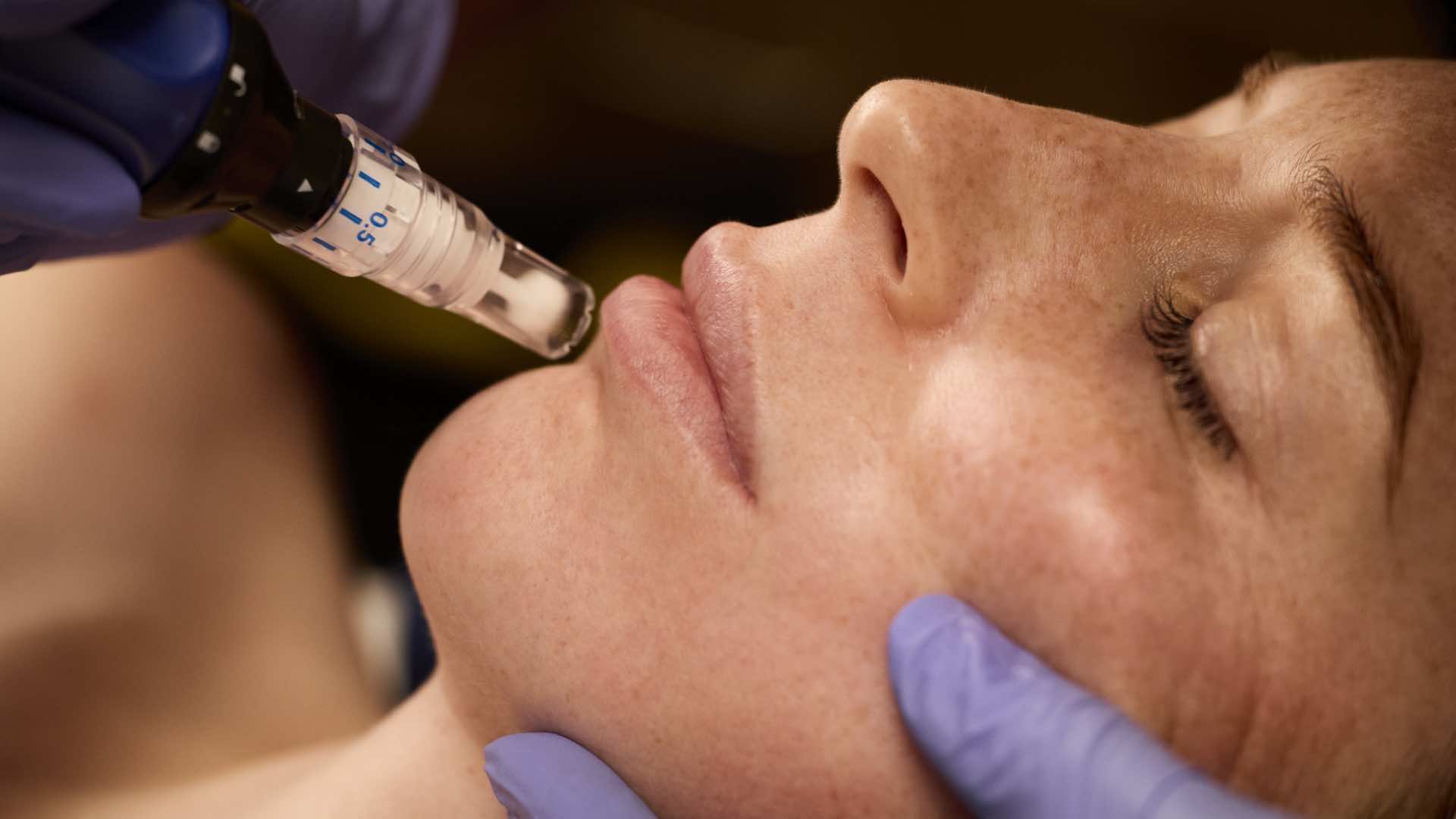 Skin Pen Microneedling at Infinity Med Spa GA Skin Pen Microneedling at Infinity Med Spa GA