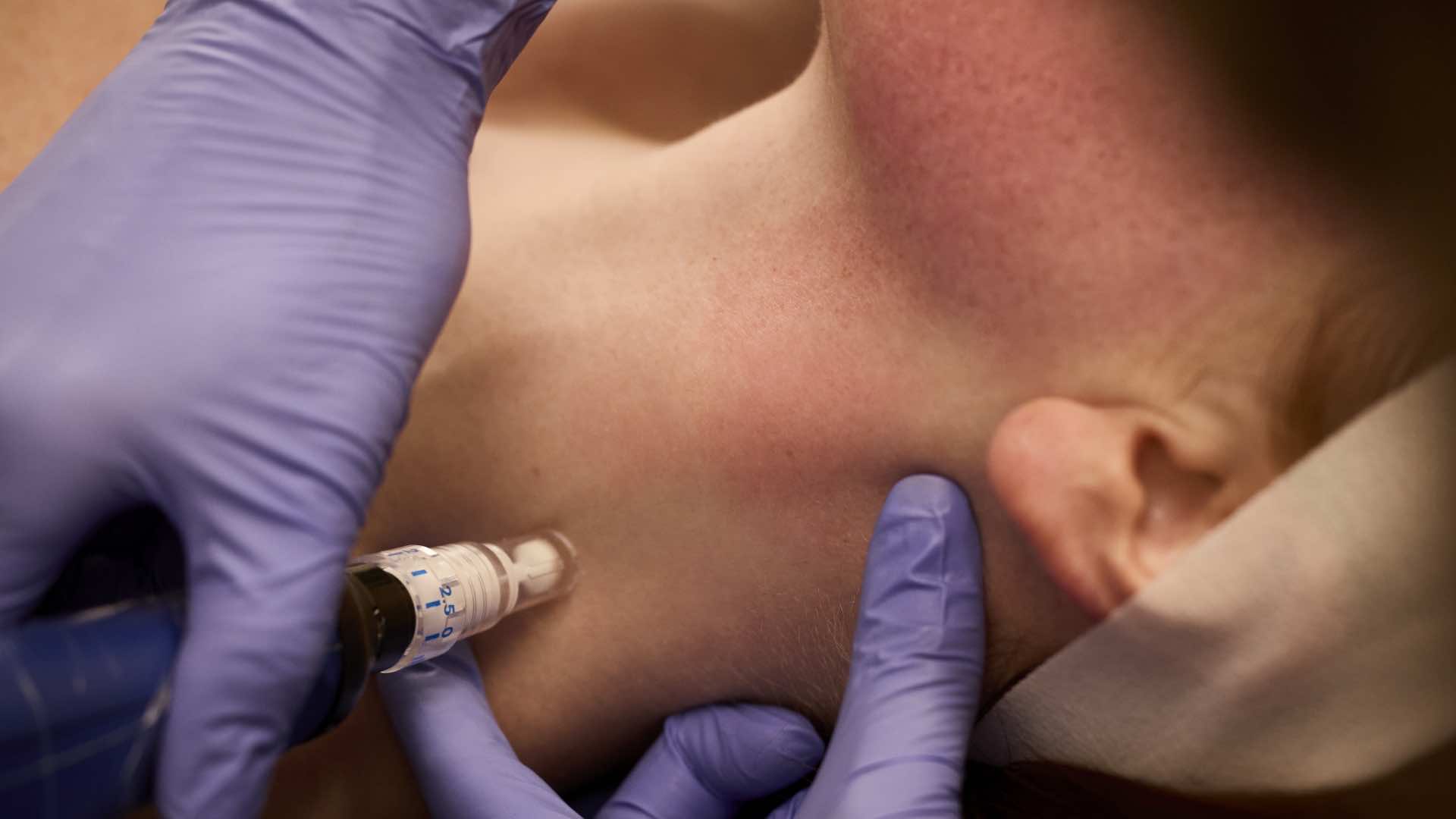 Skinpen at Infinity Med Spa GA Skinpen at Infinity Med Spa GA