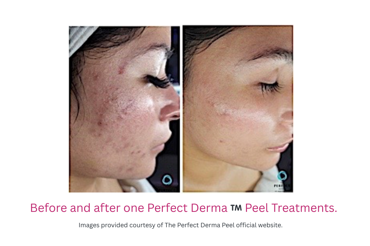 Before and after one Perfect Derma ™️ Peel Treatments Before and after one Perfect Derma ™️ Peel Treatments in Douglasville, GA
