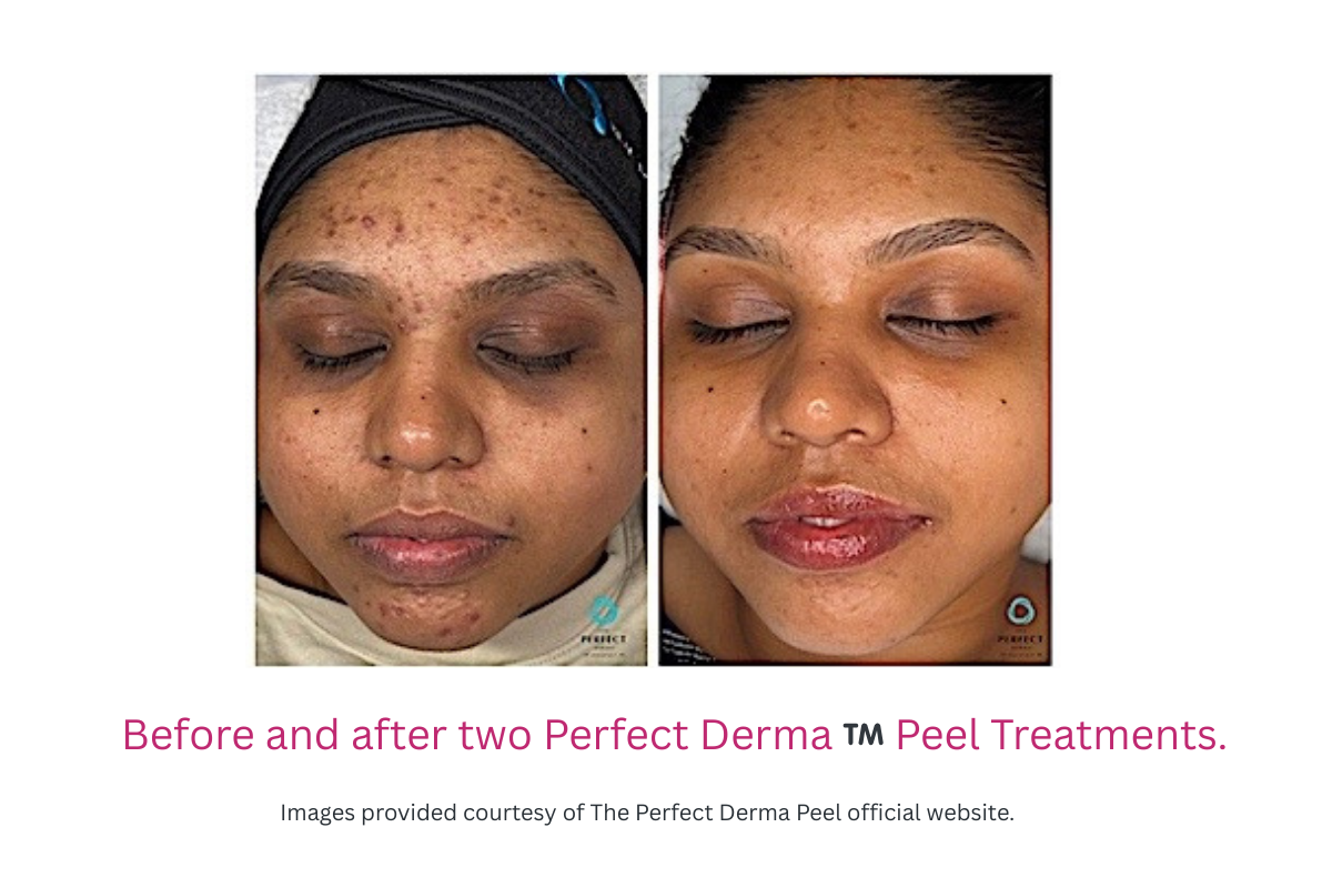 Before and after two Perfect Derma ™️ Peel Treatments Before and after two Perfect Derma ™️ Peel Treatments in Douglasville, GA