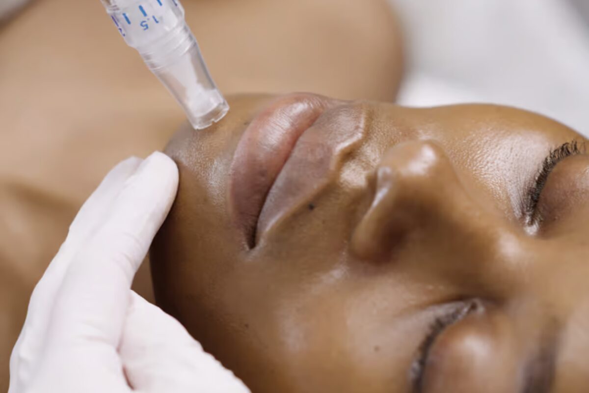 SkinPen microneedling treatment at Infinity Med Spa in Georgia