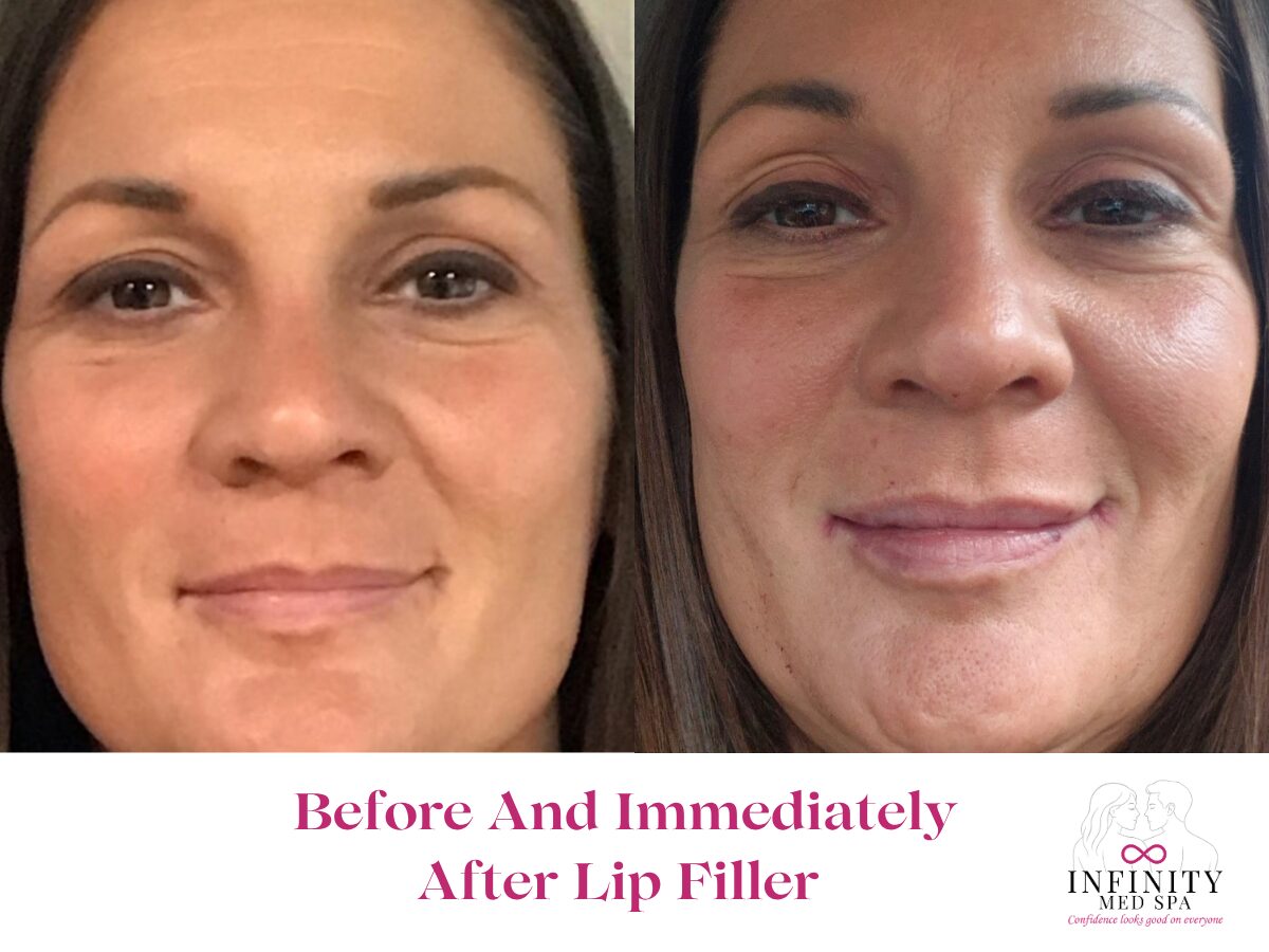 Before And Immediately After Lip Filler at Infinity Med Spa GA