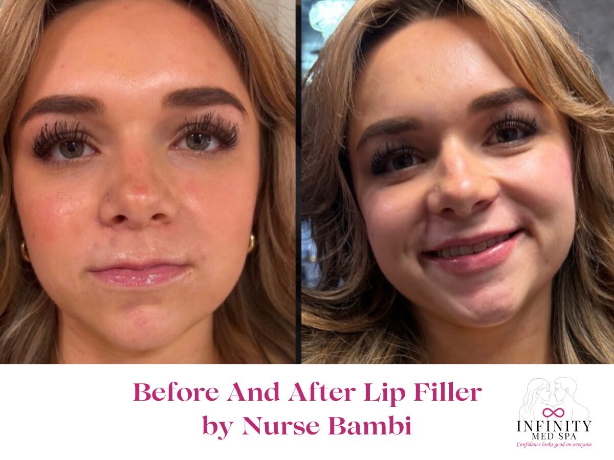 Before And Immediately After Lip Filler at Infinity Med Spa GA