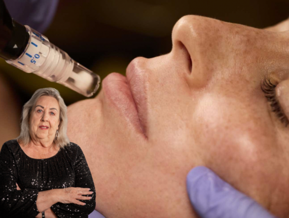 SkinPen microneedling with Nurse Bambi Plumlee at Infinity Med Spa GA in Douglasville, Georgia