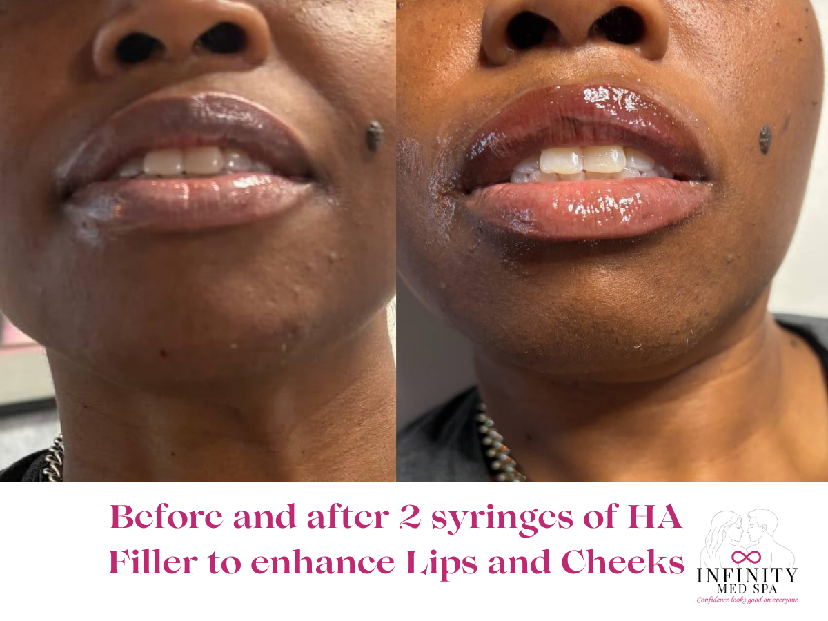 Before and after 2 syringes of HA Filler to enhance Lips and Cheeks at Infinity Med Spa GA