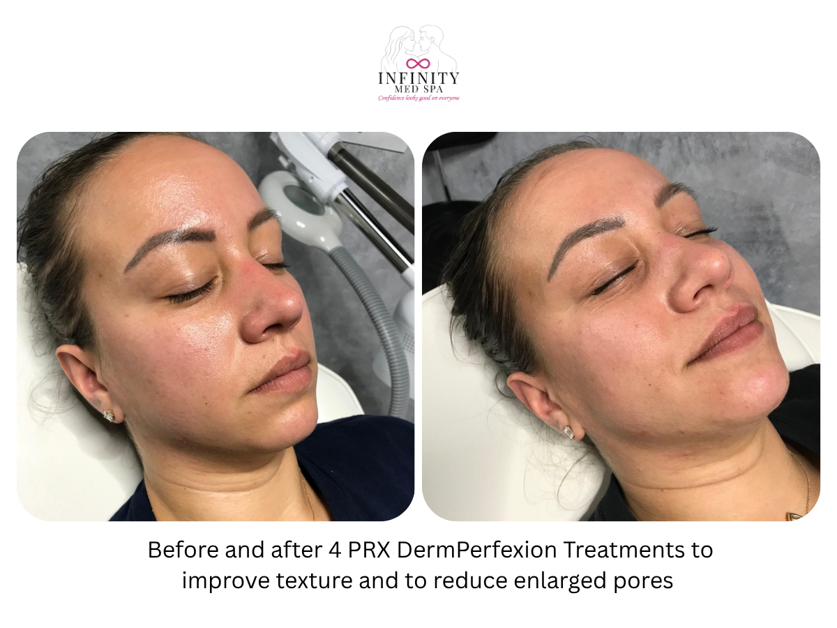 Before and after 4 PRX DermPerfexion Treatments