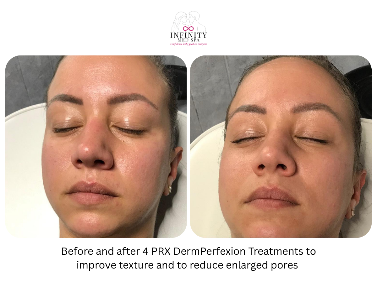 Before and after 4 PRX DermPerfexion Treatments
