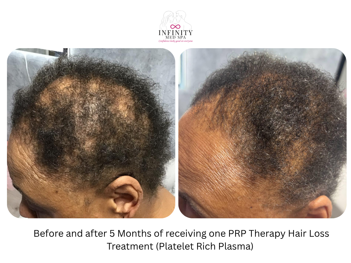 Before and after 5 Months of receiving one PRP Therapy Hair Loss Treatment (Platelet Rich Plasma)