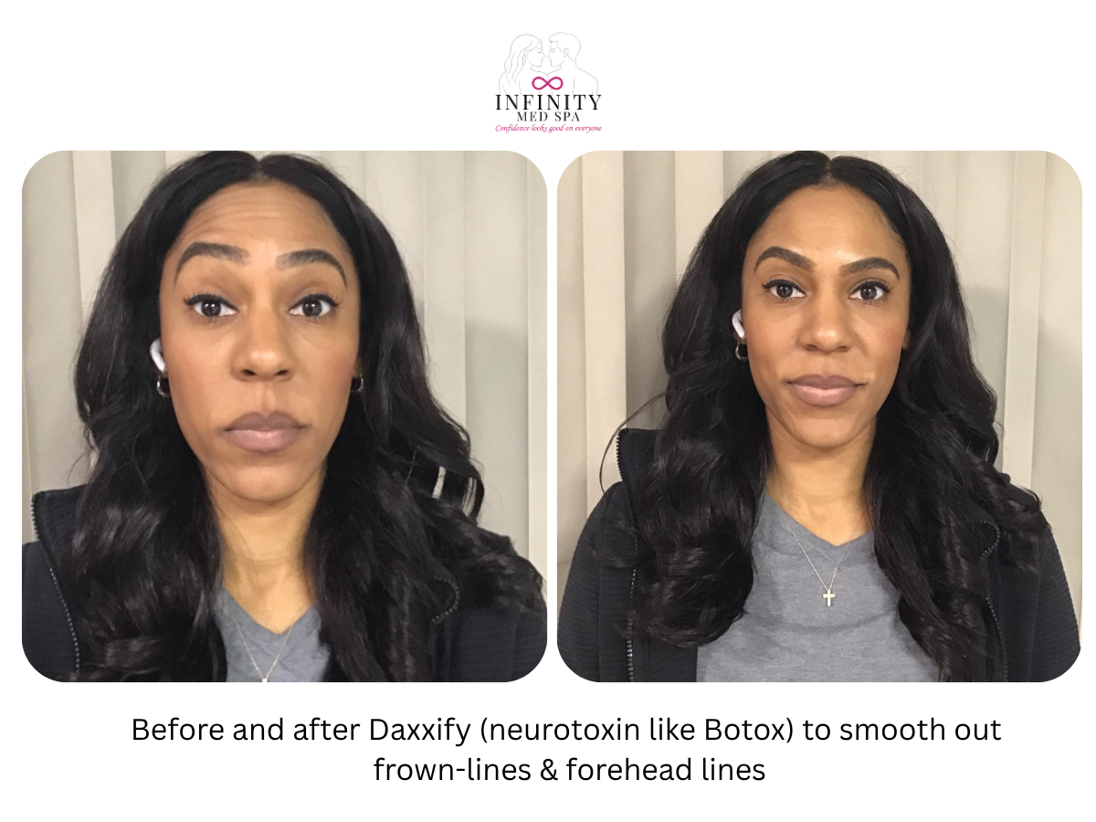 Before and after Daxxify (neurotoxin like Botox) to smooth out frown-lines & forehead lines