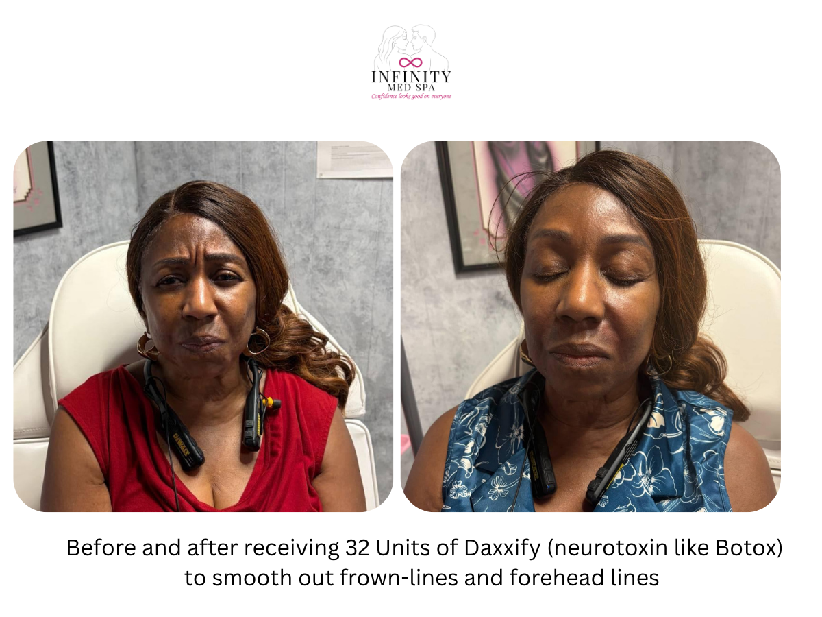 Before and after receiving 32 Units of Daxxify (neurotoxin like Botox) to smooth out frown-lines and forehead lines